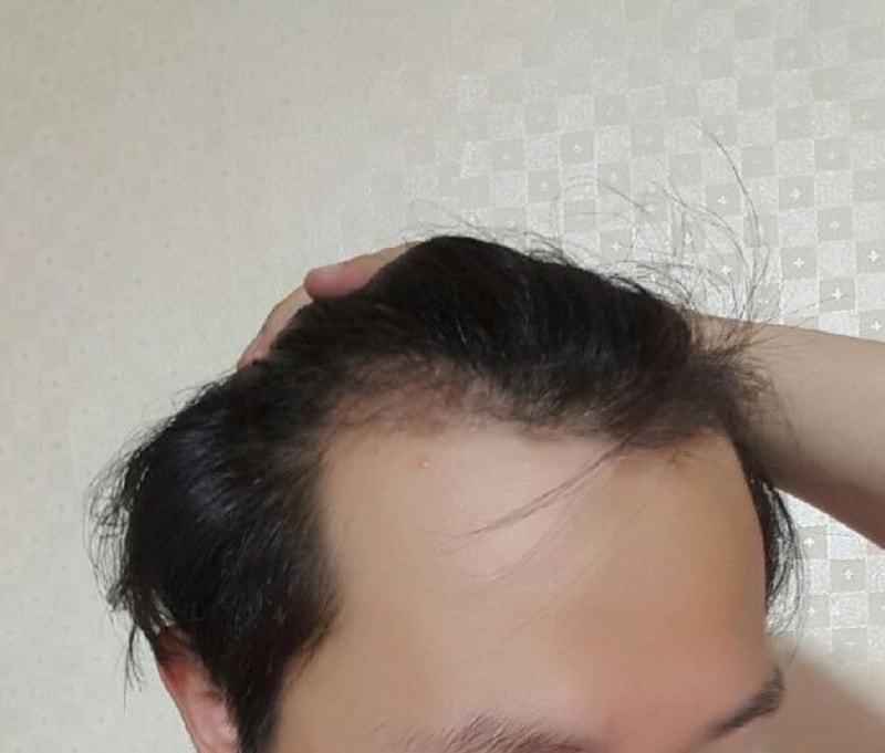 ㅍhh, it's been three months since the 1200 follicle surgery