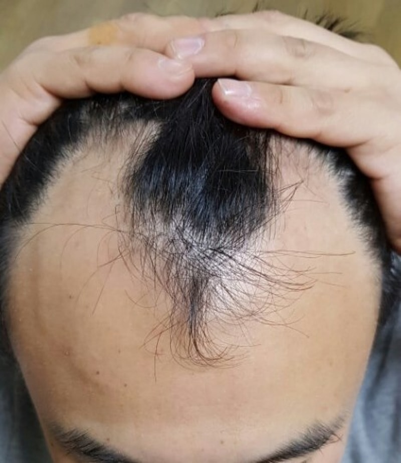 수술 5일차 경과