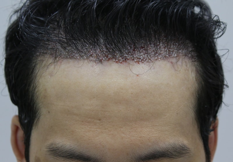 수술후.JPG