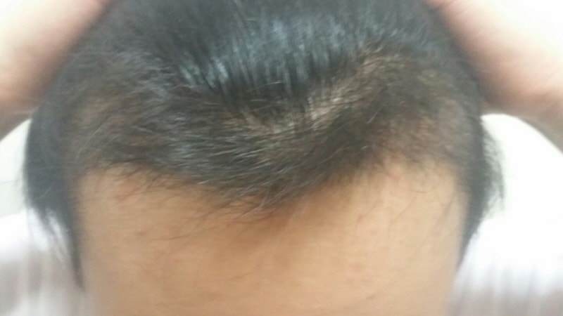 4개월 됐어요~ (포헤어 1500모낭)