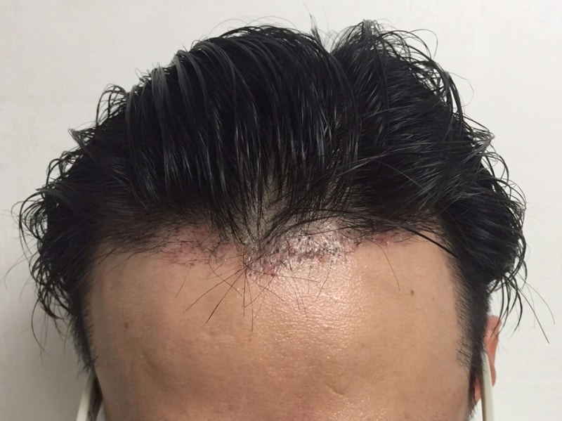모션 엠자 3000모 이식수술후 2개월 차 진입합니다.