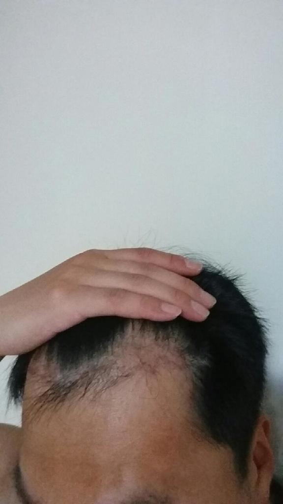 모션 1400모낭 이식 후 1년 2개월 경과 후기입니다