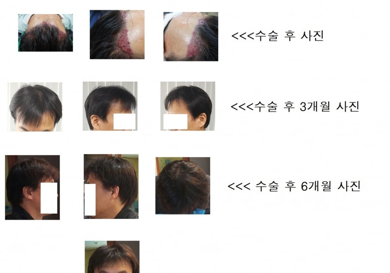 모션 엠자 9개월 1000모낭 수술 후기입니다