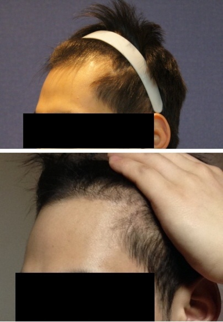 Motion hair transplant 1200 hair follicles 4 months later.