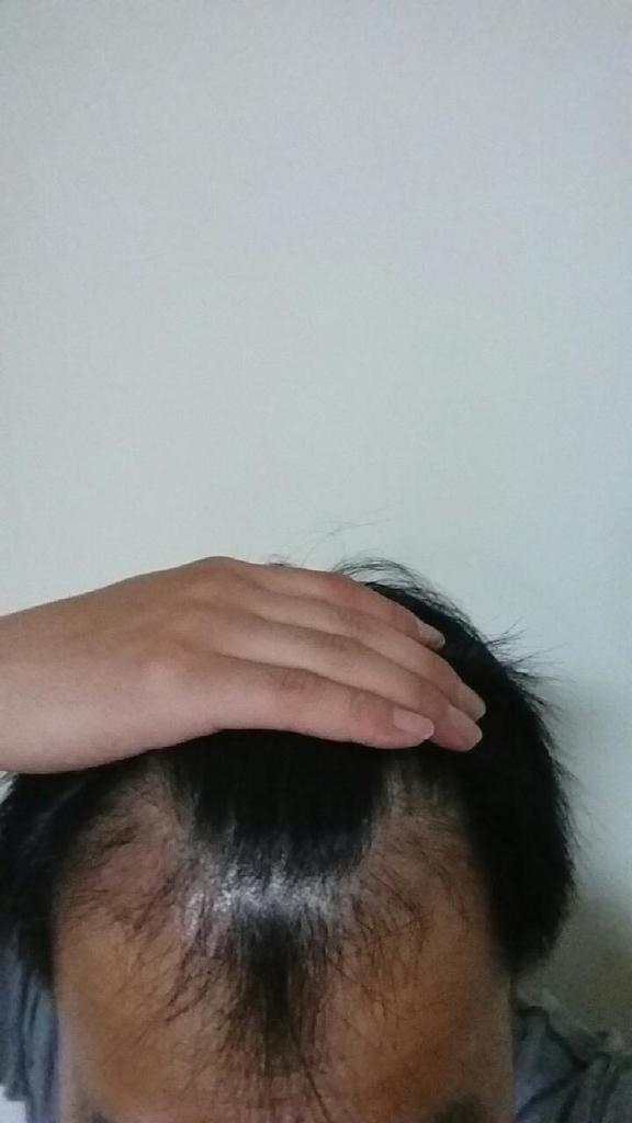 모션 1400모낭 이식 후 11개월 경과사진 후기 올려 봐요
