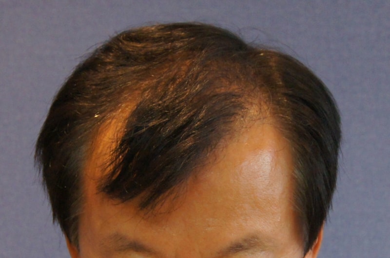 모션의 2000모 이식 1년  경과입니다