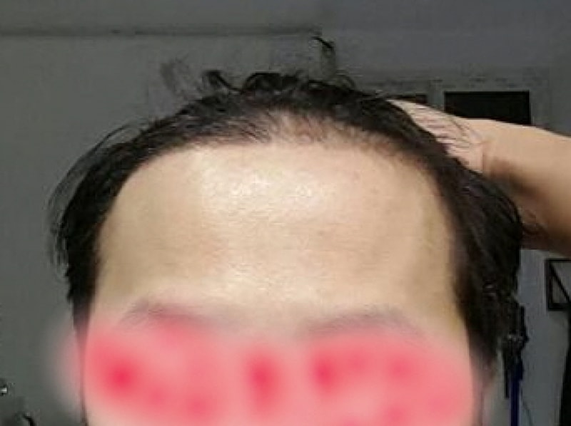 모션  1400모낭 헤어라인 1개월이 되었습니다