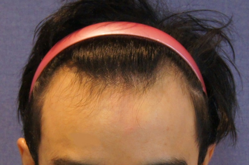 Motion 1,200 hair follicle M-shape, 1 year and 4 months, front photo
