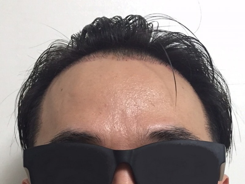 모션 엠자 3000모 이식수술후 6개월 입니다.