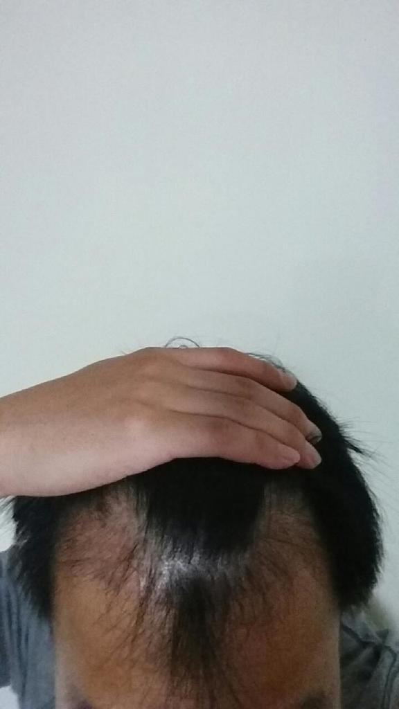모션 1400모낭 이식 후 8개월 사진 올려 봐요