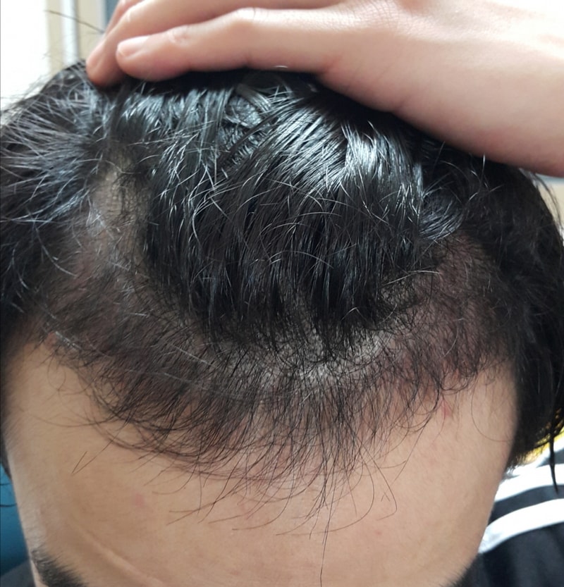 Motion 1200 hair follicles M-shaped non-cut hair transplantation 3 months later