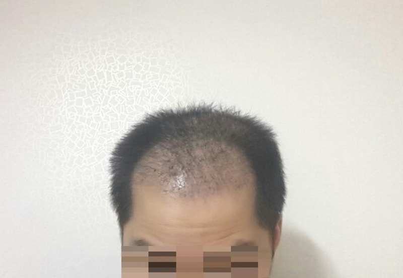 모션 2600모낭 앞머리 밀도 정수리 이식 11주 후기