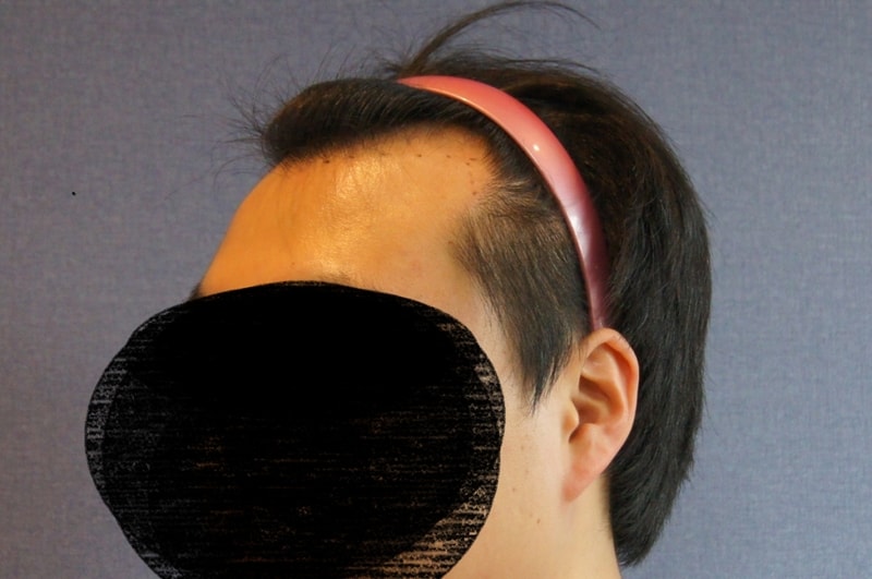 모션 1400모낭 무삭발 비절개 모발이식 2개월 사진과 소감