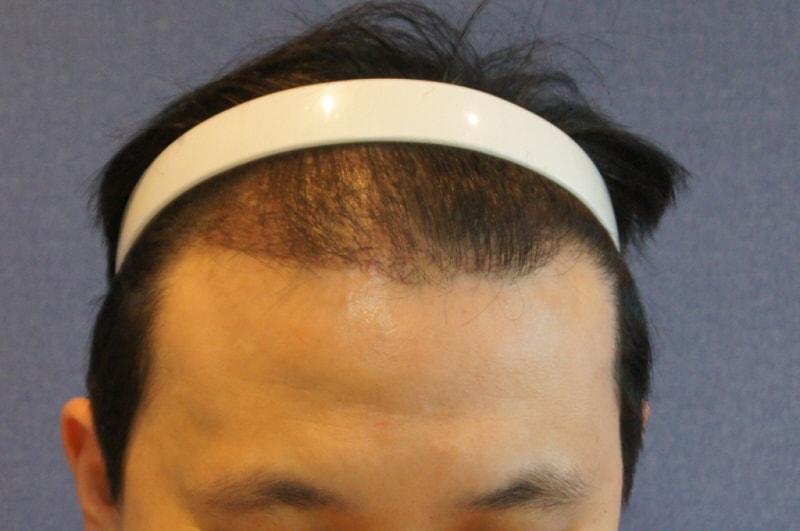 모션 엠자머리 비절개 무삭발 3200모 5개월차 경과입니다