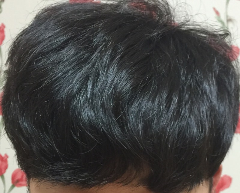 모션 1000모낭 무삭발 7개월 경과 후기