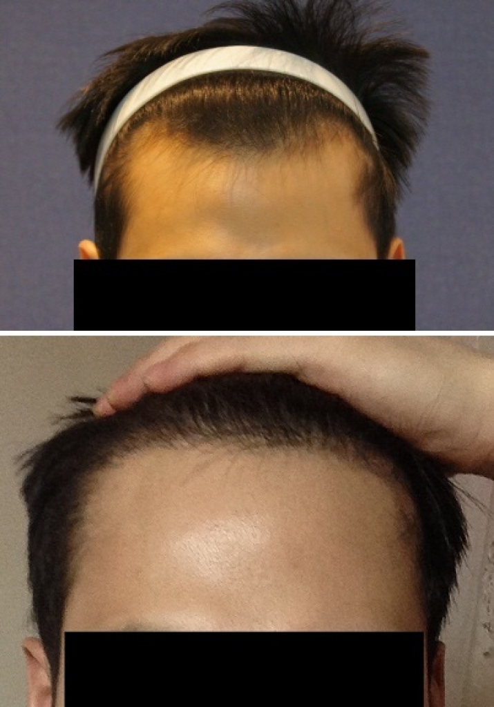 Motion hair transplant 1200 hair follicles 5 months later.