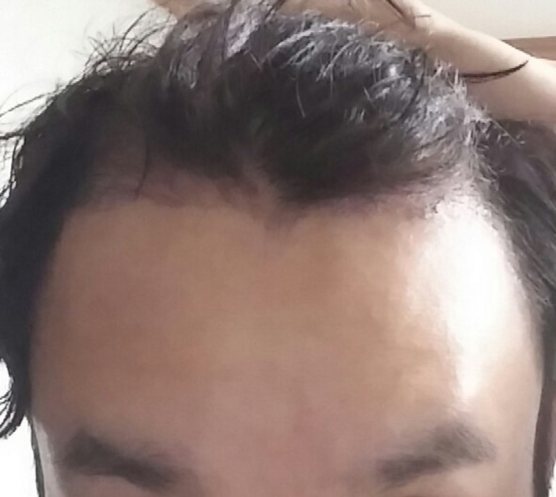 1400모낭 비절개 3개월 후기