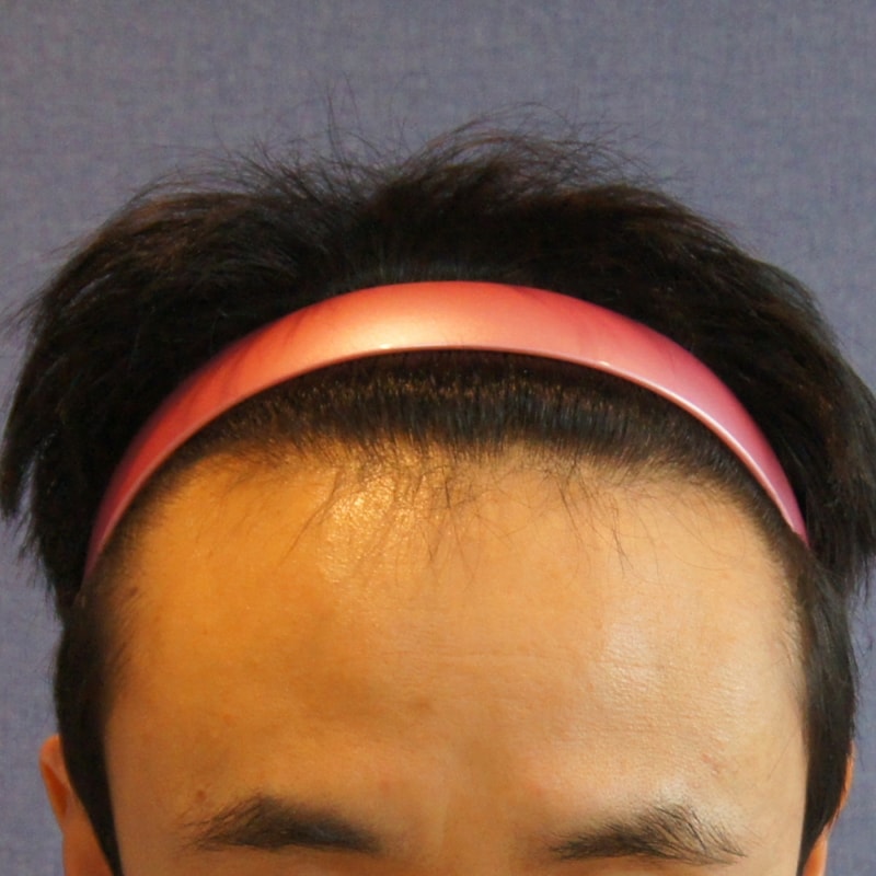 모션 1600모낭 헤어라인 모발이식후기입니다