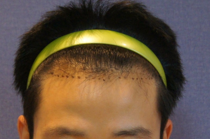 강남 모션 1200모낭 이식 10개월 후기