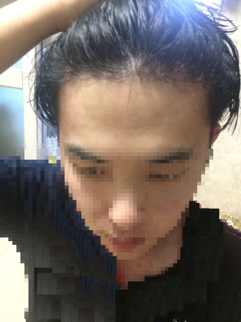 모션 1000모낭 무삭발 3개월 경과 후기