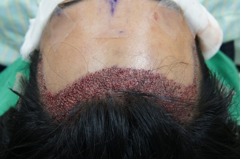 모션 1200모낭 이후 3개월 후기 경과