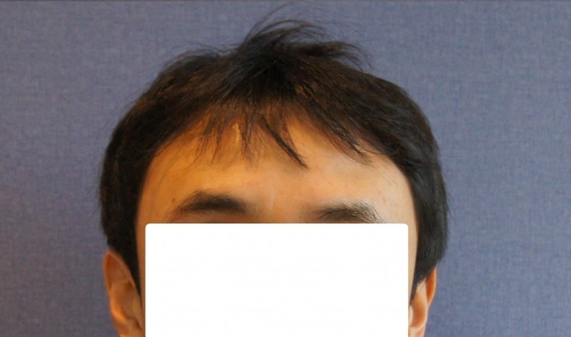 모션 1600모낭 헤어라인 12개월 모발이식 경과