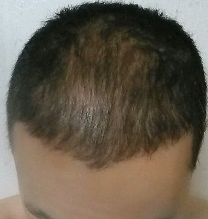 모션 2000모낭 비절개법 모발이식 8개월 경과 후기