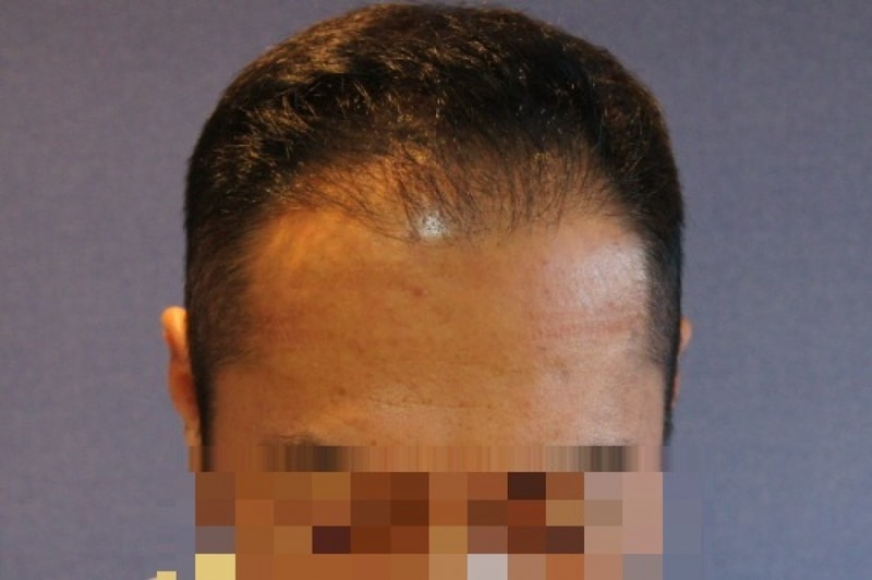 1400모낭 밀도보강 2차 수술 6개월 사진