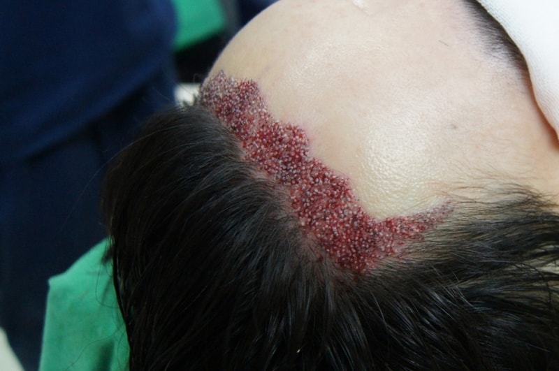 모션 1200모낭 헤어라인 수술 1년 5개월 경과