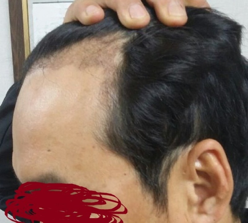 모션 1400모낭 비절개 모발이식 수술 4개월 경과입니다