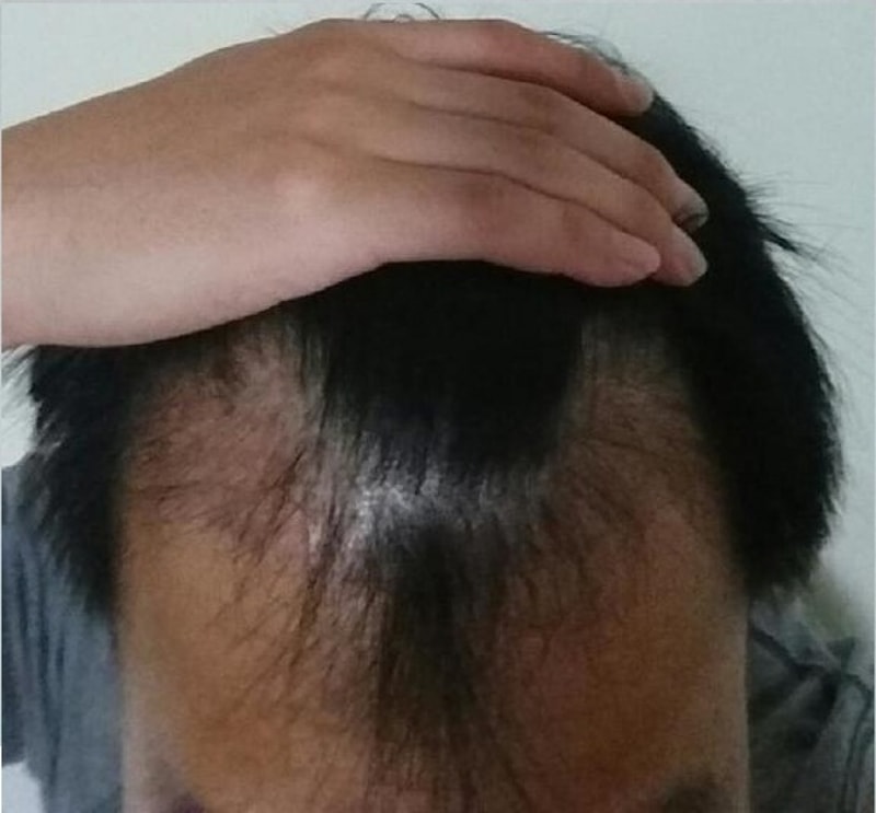 모션 1400모낭 이식 후 1년 경과 후기입니다