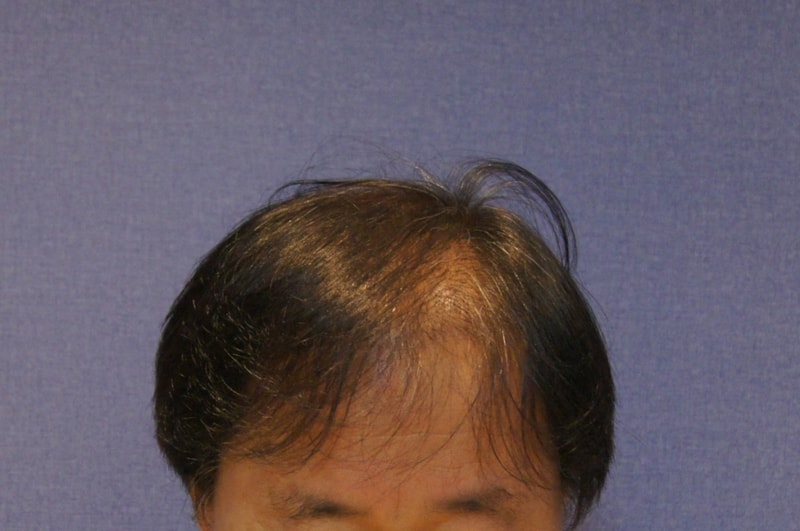 모션 앞머리와 정수리 4000모 11개월 입니다