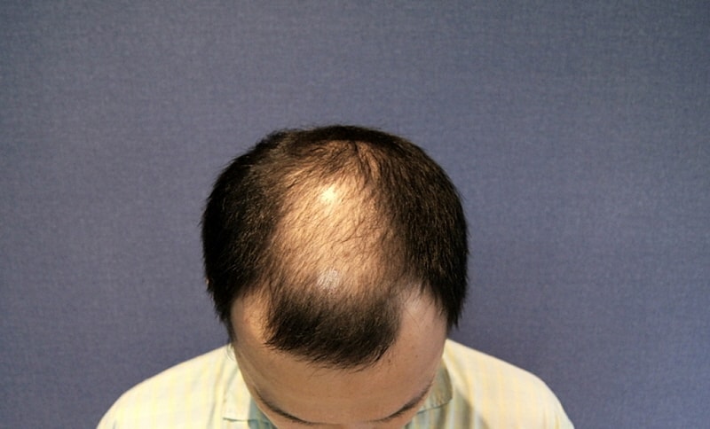 2400 follicle motion 6 months post-transplantation mid-term