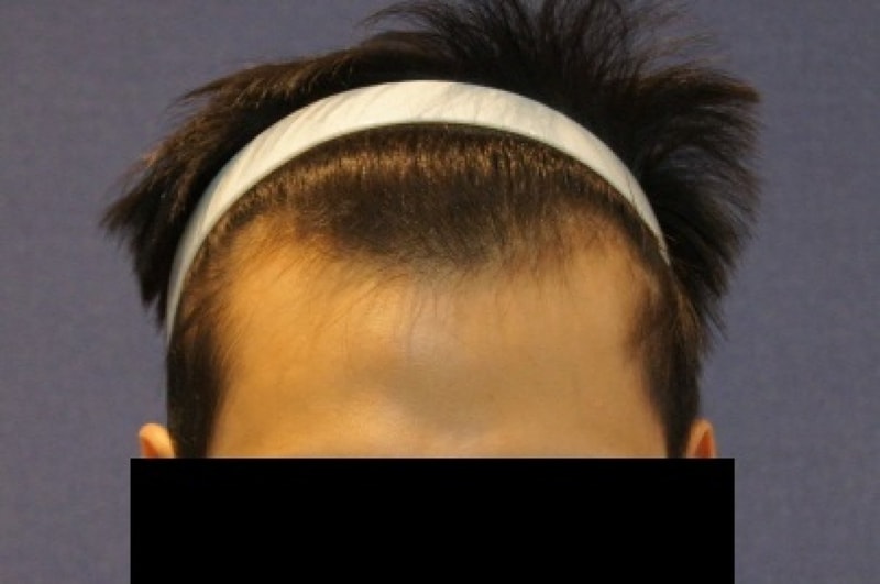 Motion non-cut hair transplant 1200 hair follicles 10 months later.