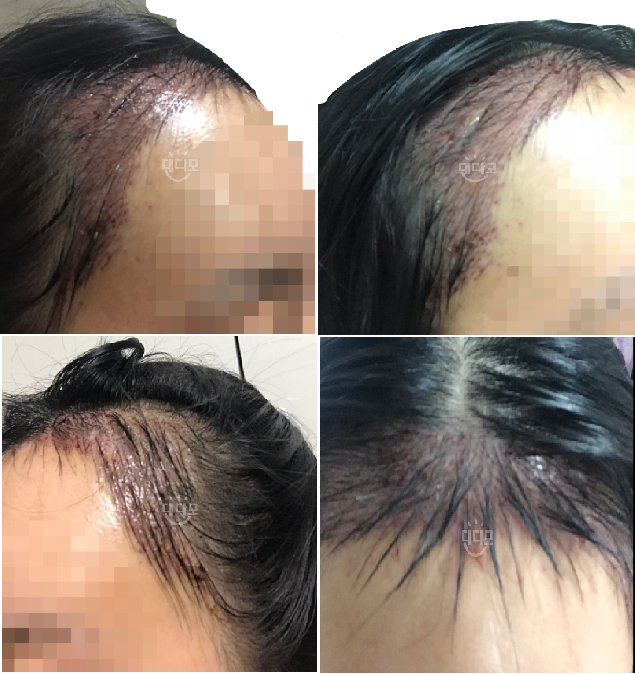 1700모낭 수술후 3일까지 솔직후기