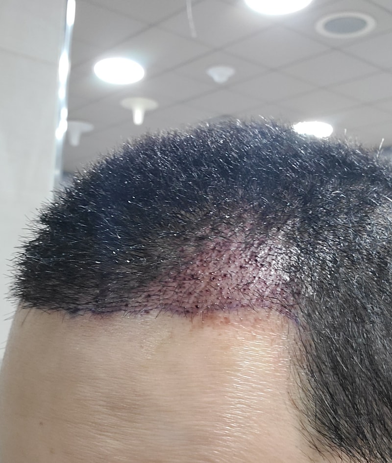 수술 후 당일 측면2.jpg