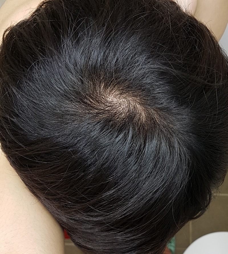정수리 D+180 대박