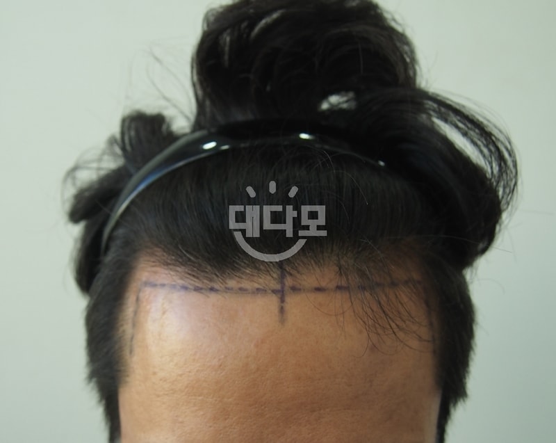 수술직전 1.jpg