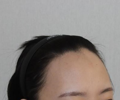 모발이식 한지 벌써 2주째 지나가요