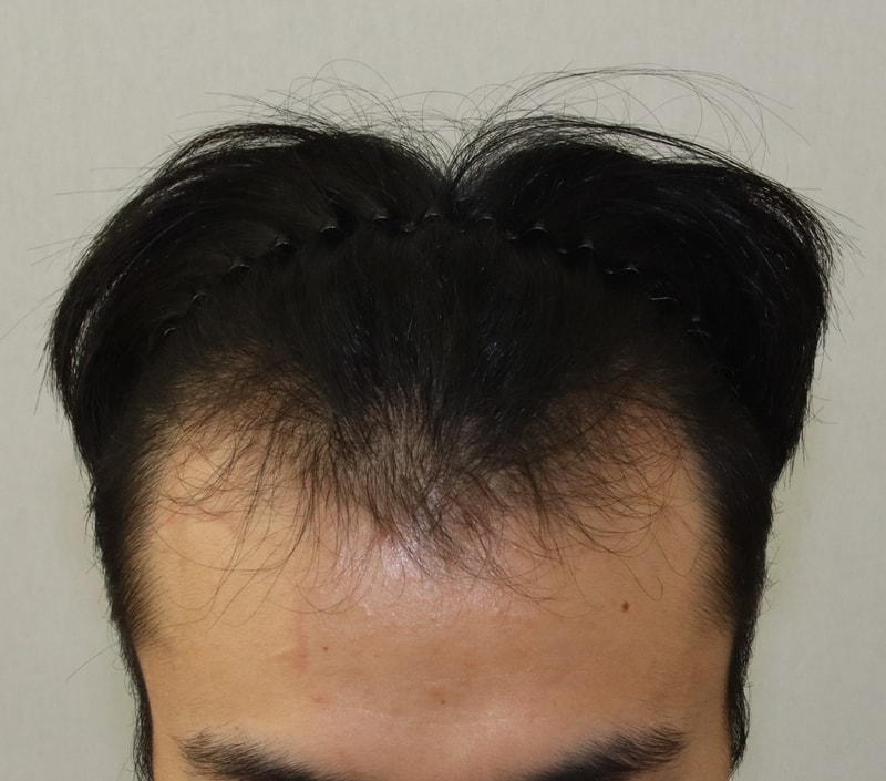 9개월째 비절개 모발이식 후기 남깁니다!