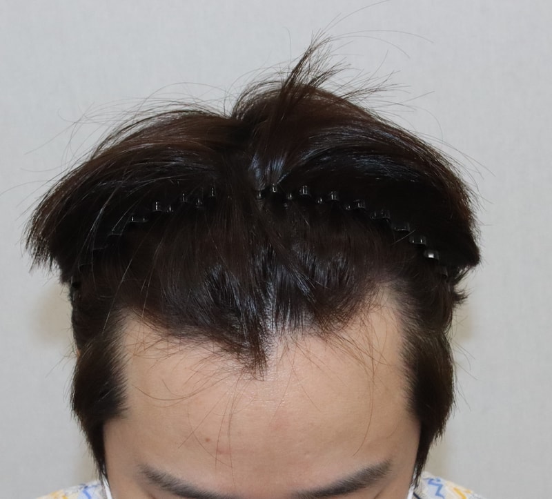 3000모 비절개 모발이식 9개월 경과 후기입니다 사진 有