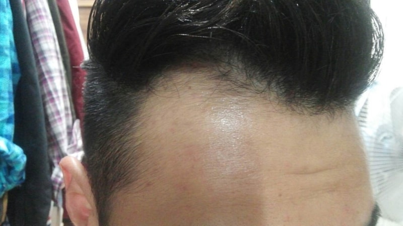 M자 무삭발 비절개 베지터탈출 했습니다(jp후기 3차)