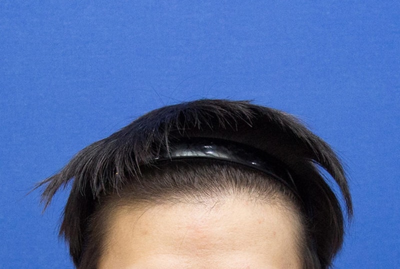 이식전.png