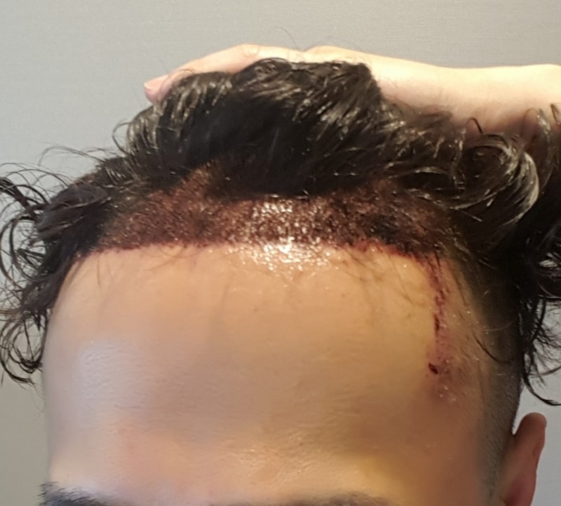 I had 1600 hair follicle surgery by non-cut.