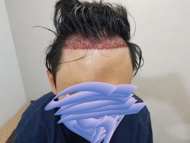 오늘 비절개 1400모낭 후기입니다