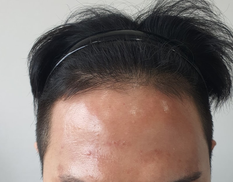 이식 전.jpg