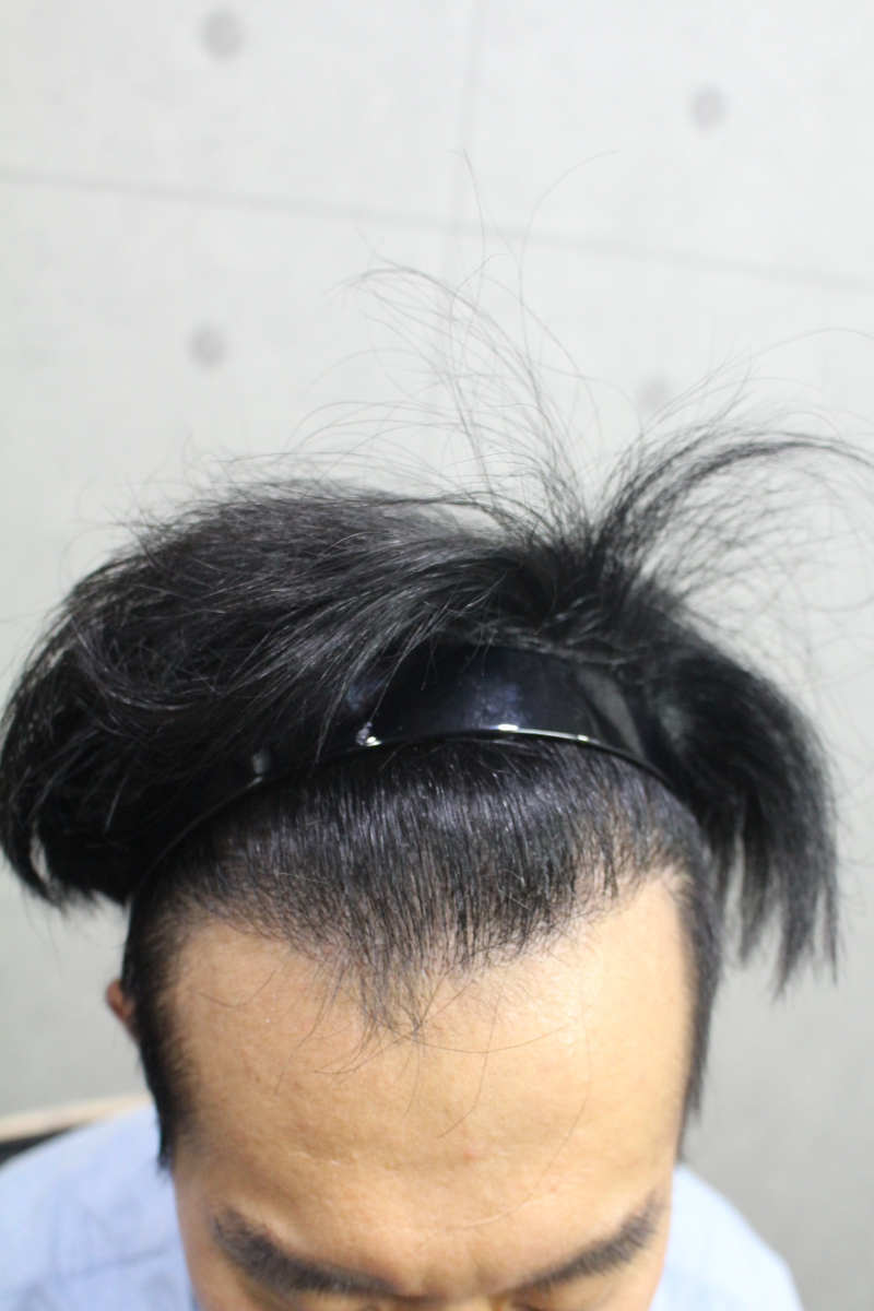 한나이브 절개 9개월차 입니다.