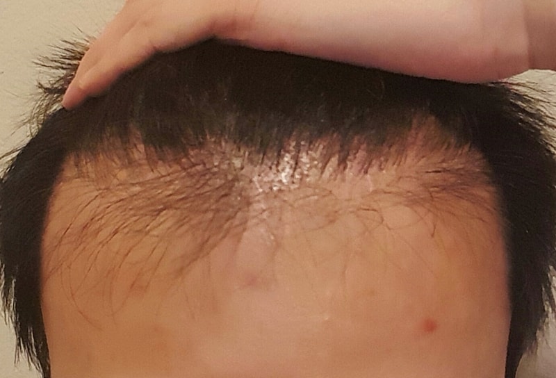 재수술 후 3개월 1.jpg