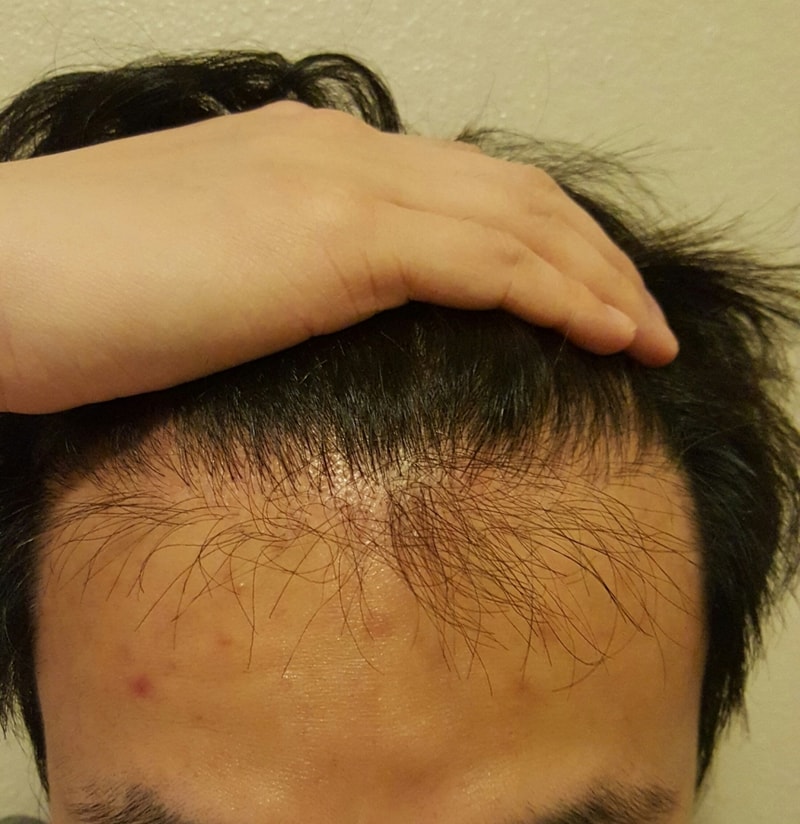 재수술 후 3개월.jpg