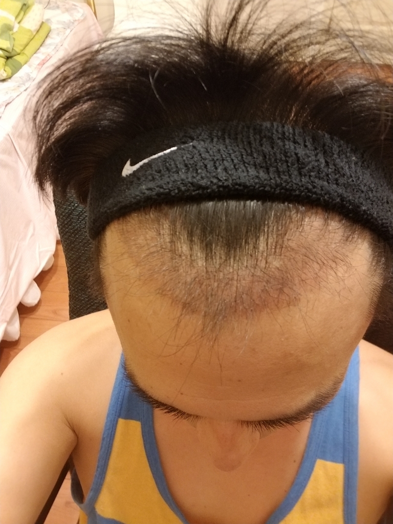 비절개 무삭발 두달사진